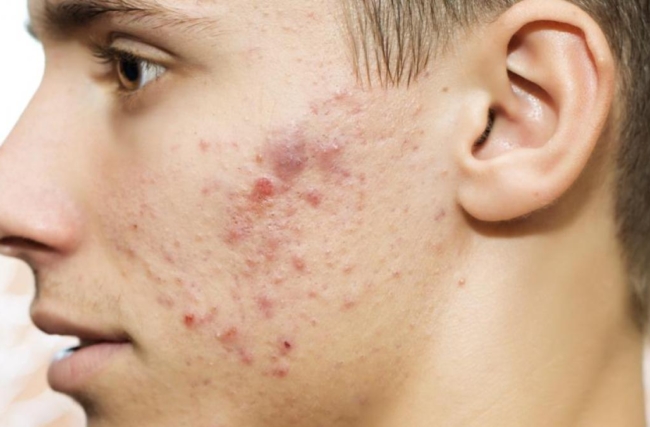Tudo o que você precisa saber sobre Roacutan: O tratamento para acne mais eficaz